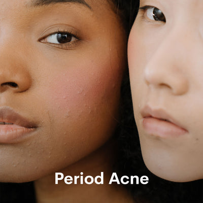 Period Acne